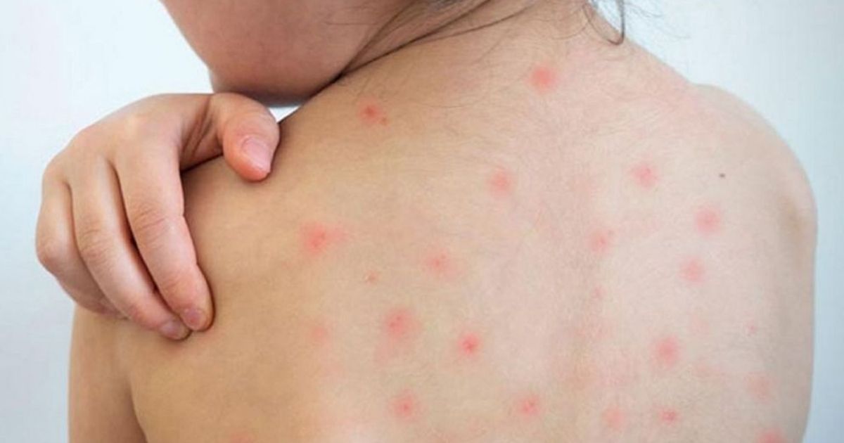 ১৯ দিনে হামের উপসর্গ নিয়ে প্রাণ হারাল ৯৪ শিশু